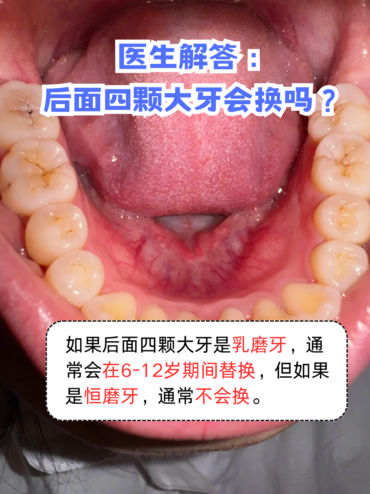 孩子牙齿替换有明确的规律,后面的大牙是否会换,关键看它是乳磨牙