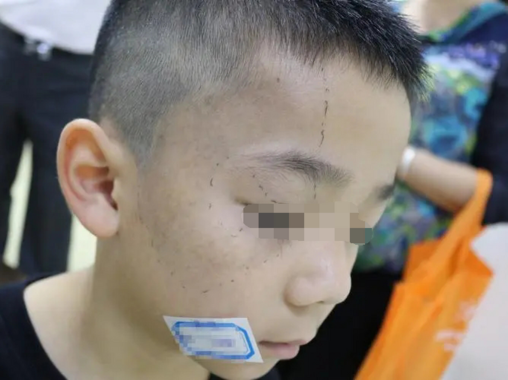 太田痣发于面部,但新技术治疗下临床治愈率能达到100%,尽早治疗,配合