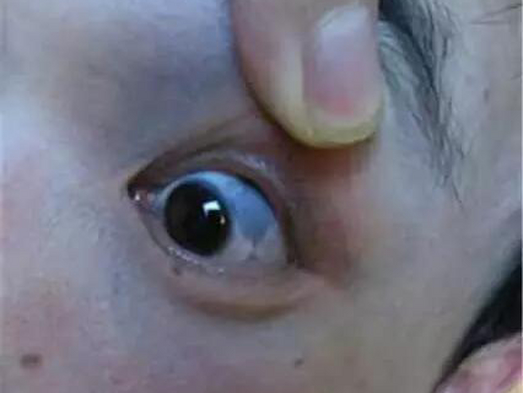 太田痣约有三分之二的患者同侧巩膜蓝染或褐色斑点,有时眼睑结合膜