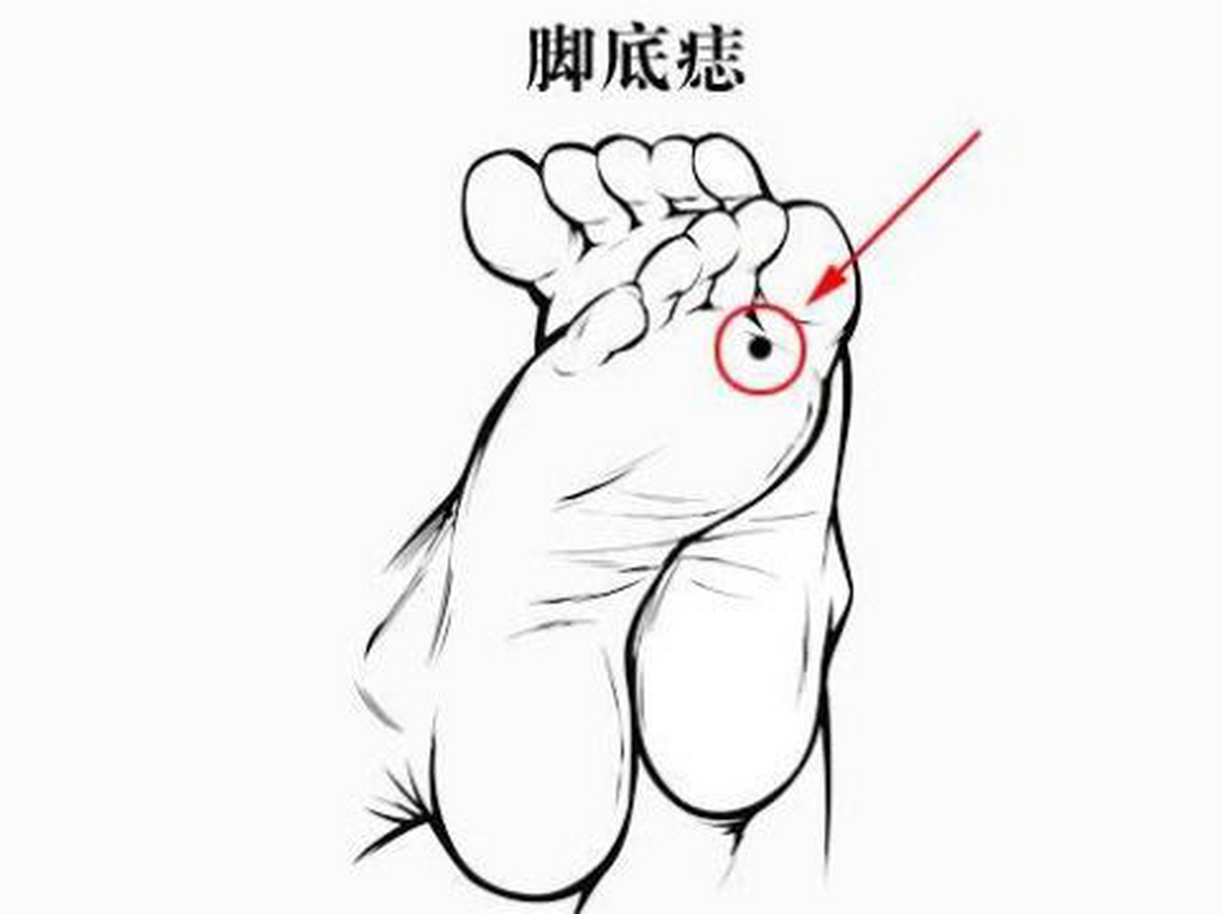 黑痣经常摩擦,这些部位要注意  1,皮带区:挤压摩擦会使恶变风险增大