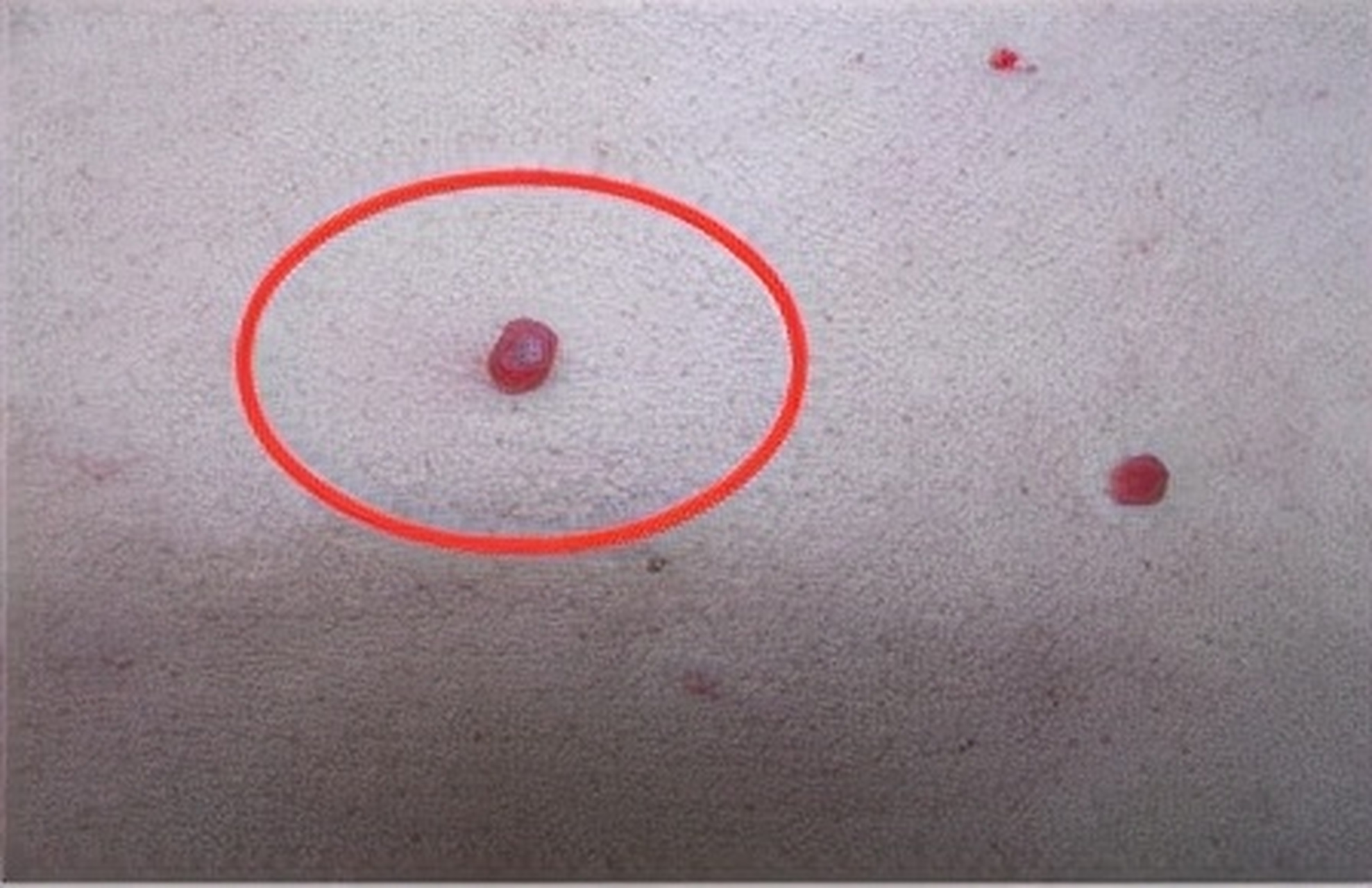 成人身上最常见的血管瘤是樱桃状血管瘤,这是一种良性的皮肤血管畸形