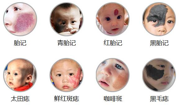 胎记治疗后需要怎么护理?