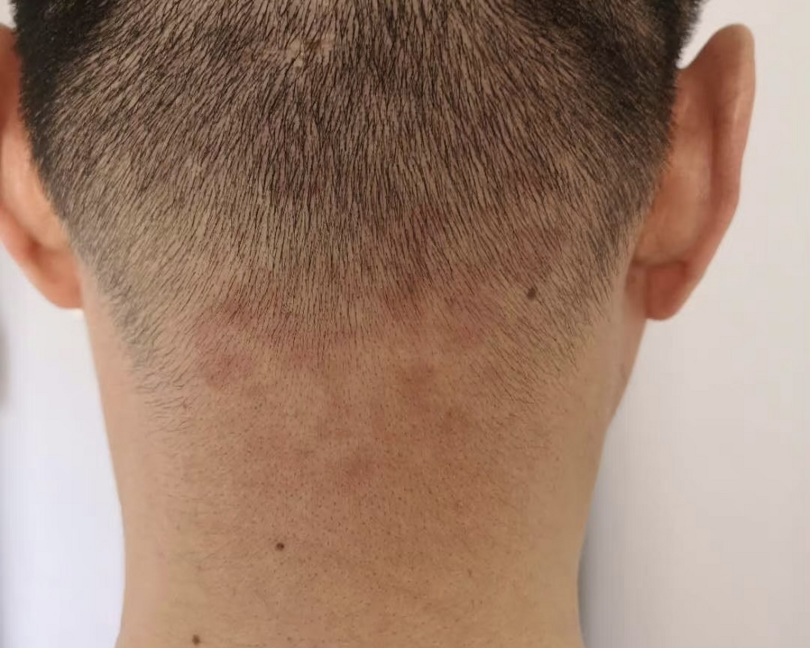 鲑鱼斑# 这就是典型的鲑鱼斑,这位朋友一年前偶然发现,为此担心了很