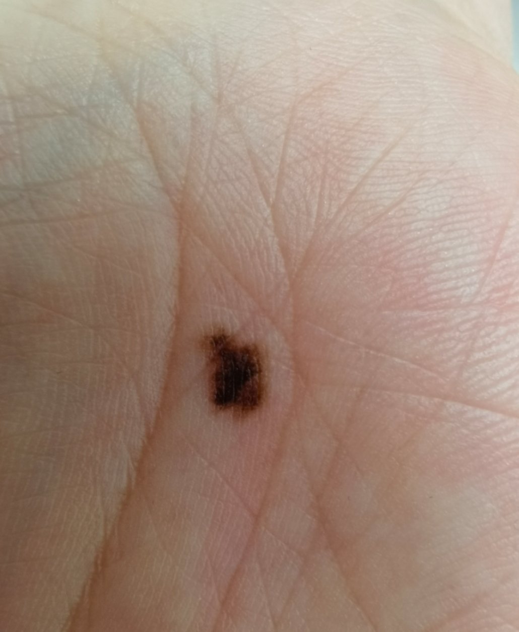 这是长在手掌位置的色素痣