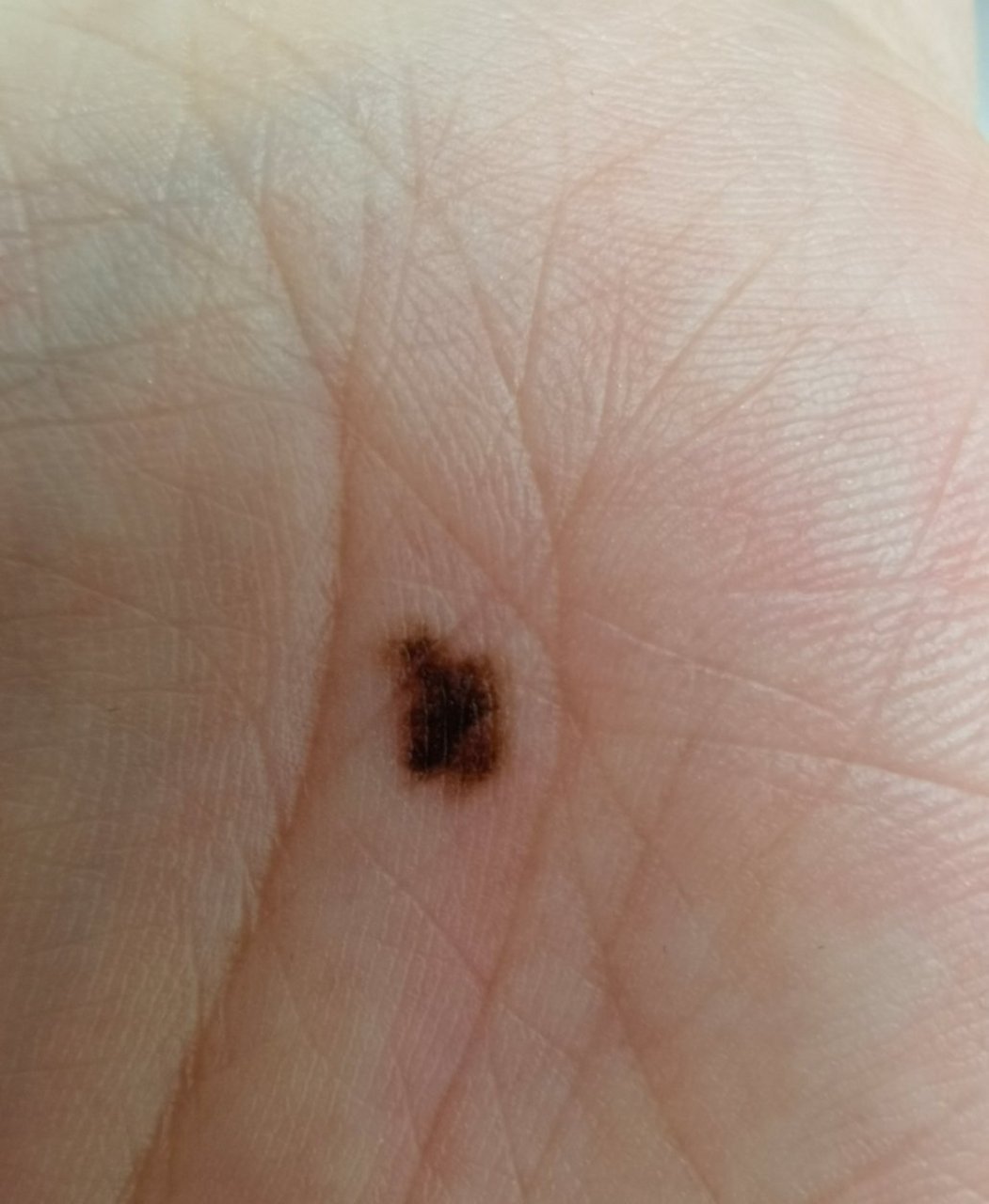 这是长在手掌位置的色素痣  按照民间说法,掌心痣有福气,能抓财.