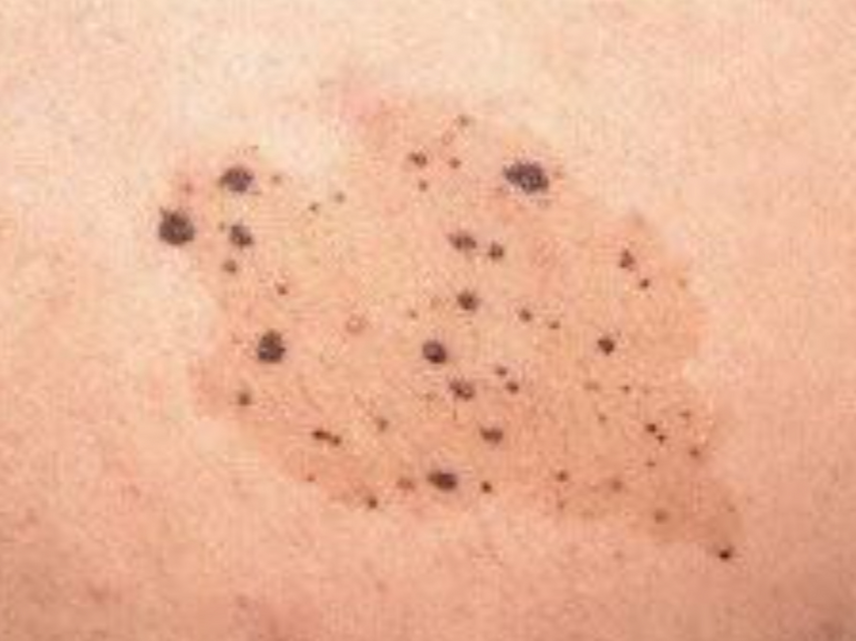 雀斑样痣的类型有哪些?