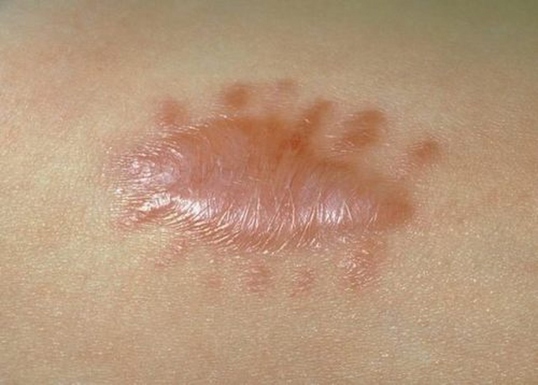 新伤口期(1-15天) 这个时期疤痕发红,是因为刚开始受伤,局部炎症