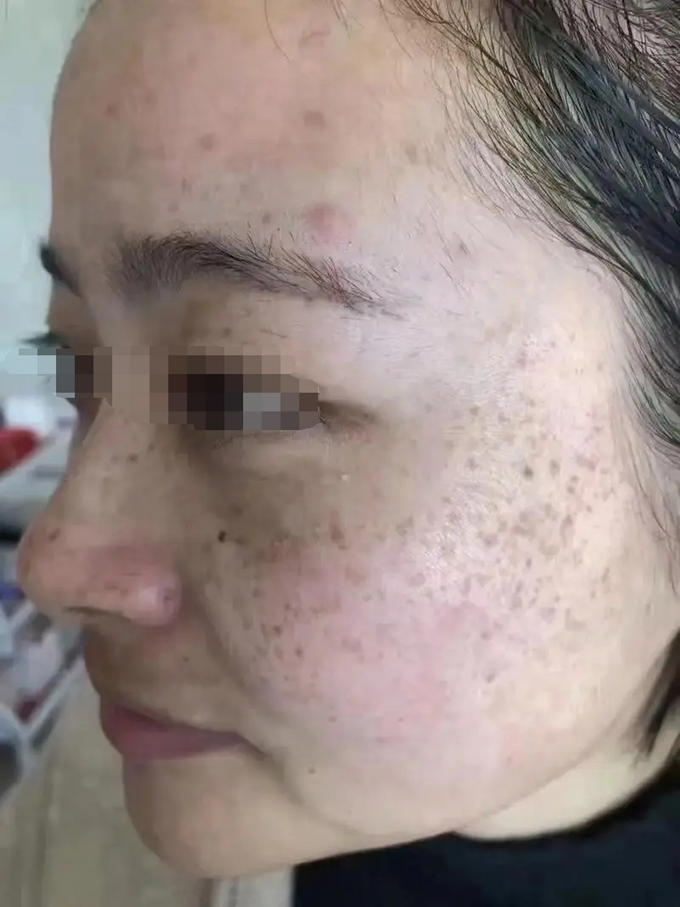 它们不是一个东西哦~  雀斑表面光滑,属于遗传性皮肤病,主要与日晒