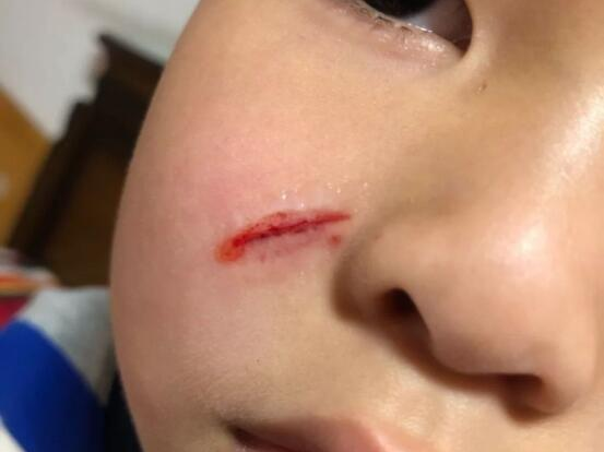 要做什么  1用干净的纱布或者毛巾压迫伤口止血 2急诊科伤口消毒包扎