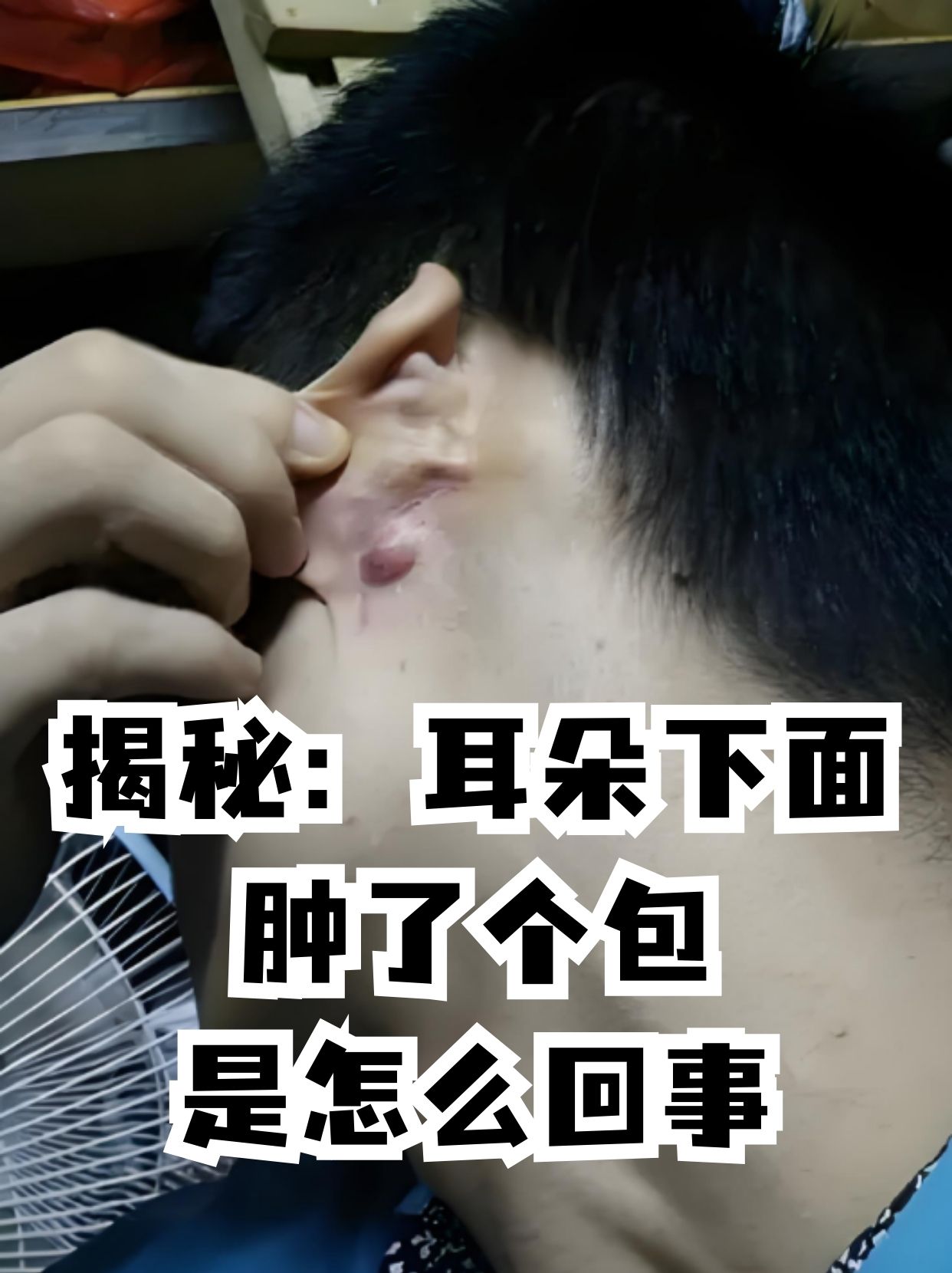 揭秘:耳朵下面肿了个包是怎么回事 很多人都遇到过这样的情况,明明好