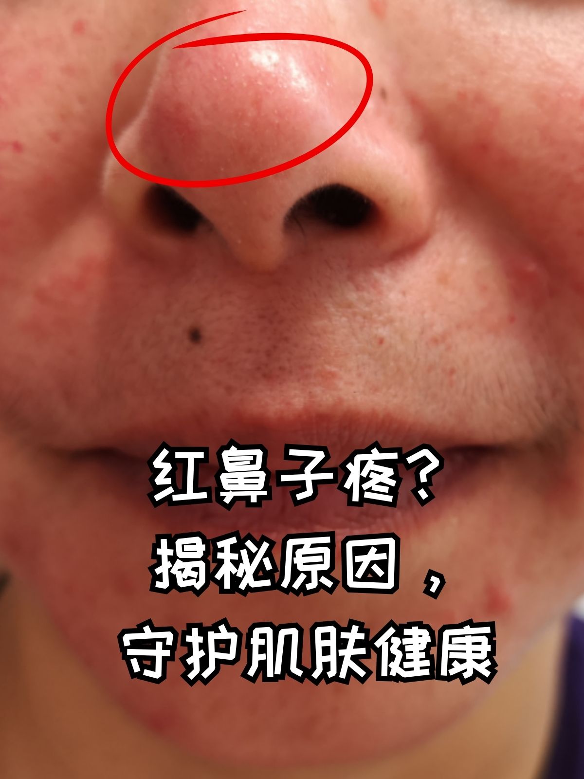 红鼻子疼?