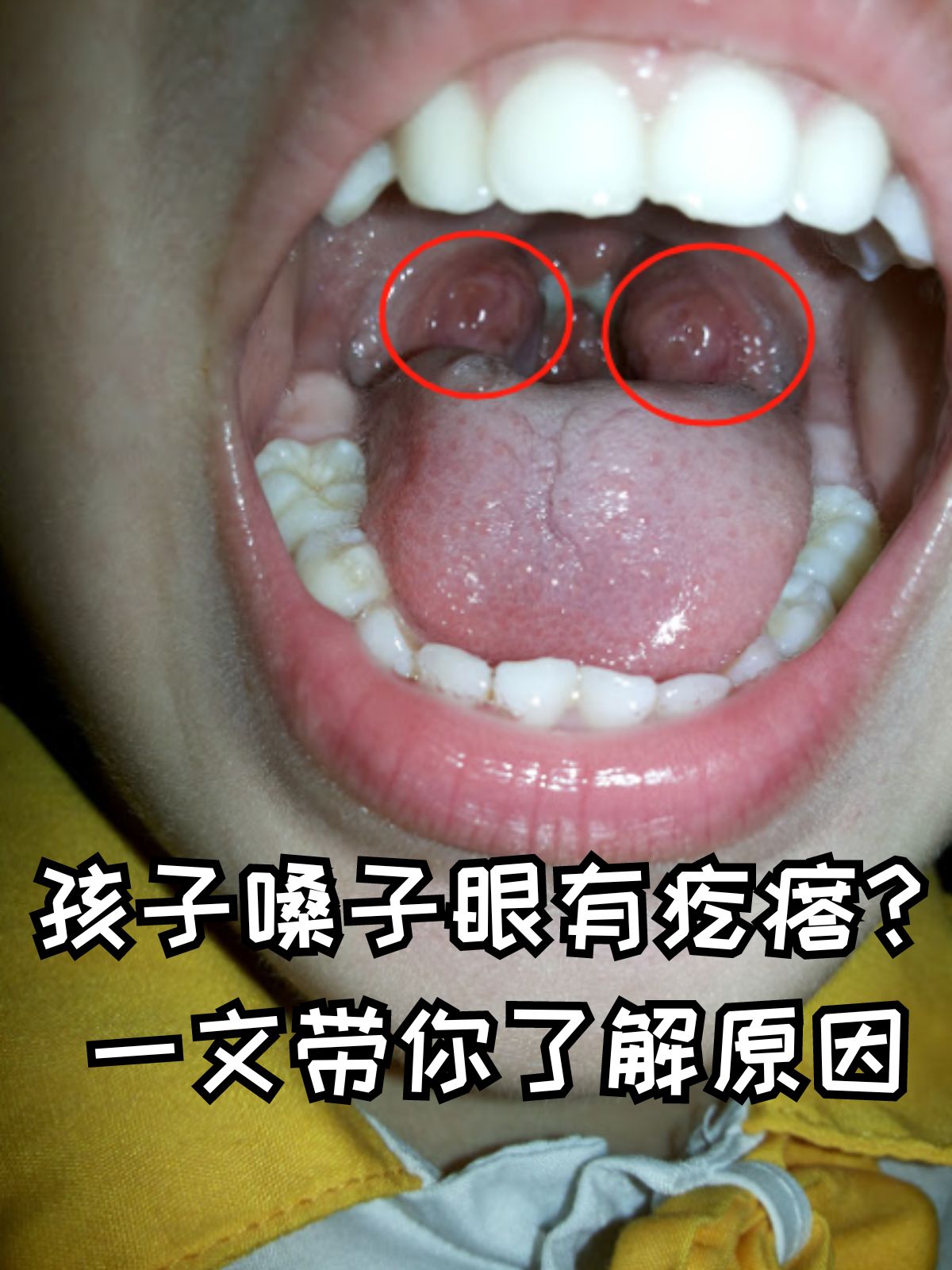 孩子嗓子眼有疙瘩?
