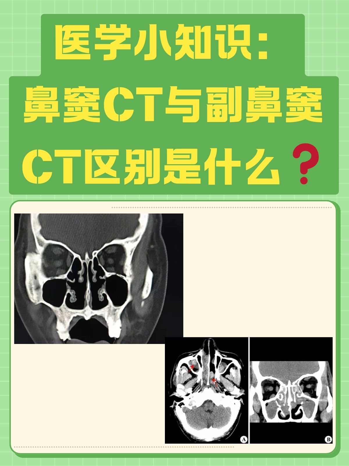 额窦气化图片