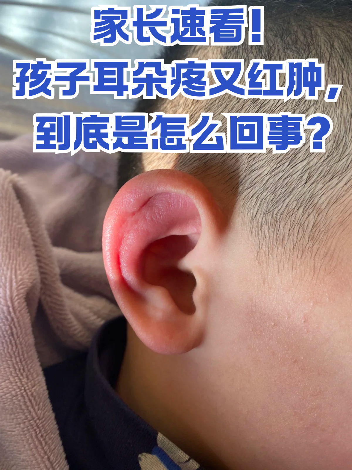 小孩耳朵疼红肿可不是小事,下面就给大家详细讲讲造成这一现象的常见