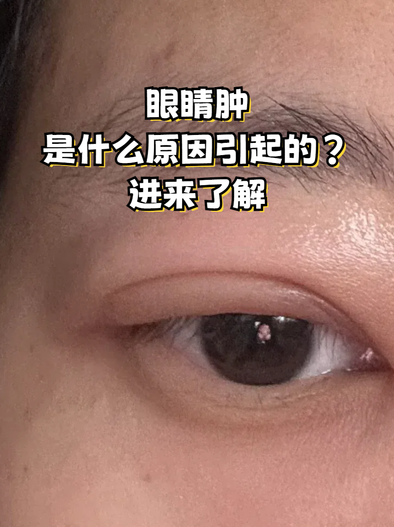为什么眼皮肿