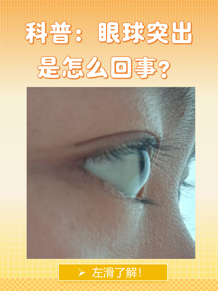 眼球突出的改善方法: 高度近视:佩戴框架眼镜矫正视力眼球突出眼球凸