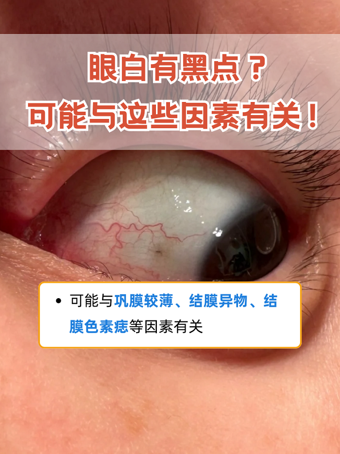 眼白一般指巩膜,是眼球壁的重要组成部分,质地较为坚硬,呈瓷白色