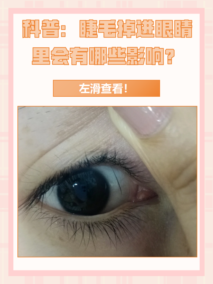 眼睛已 睫毛掉眼睛里面了弄不出来怎么办毛囊种植睫毛失败图片睫毛掉