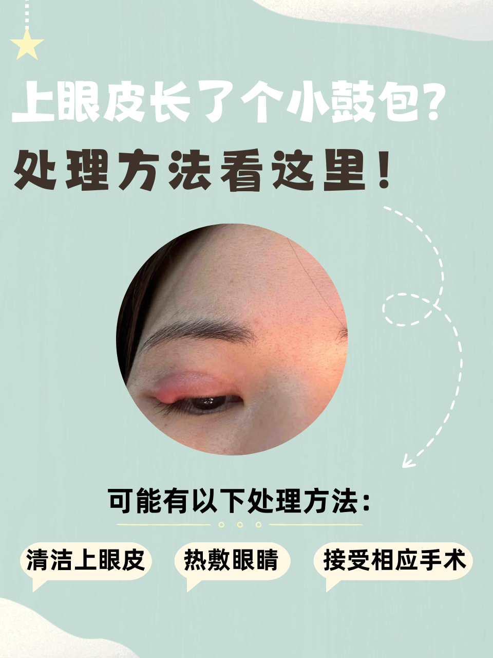 为什么上眼皮肿 为什么上眼皮肿