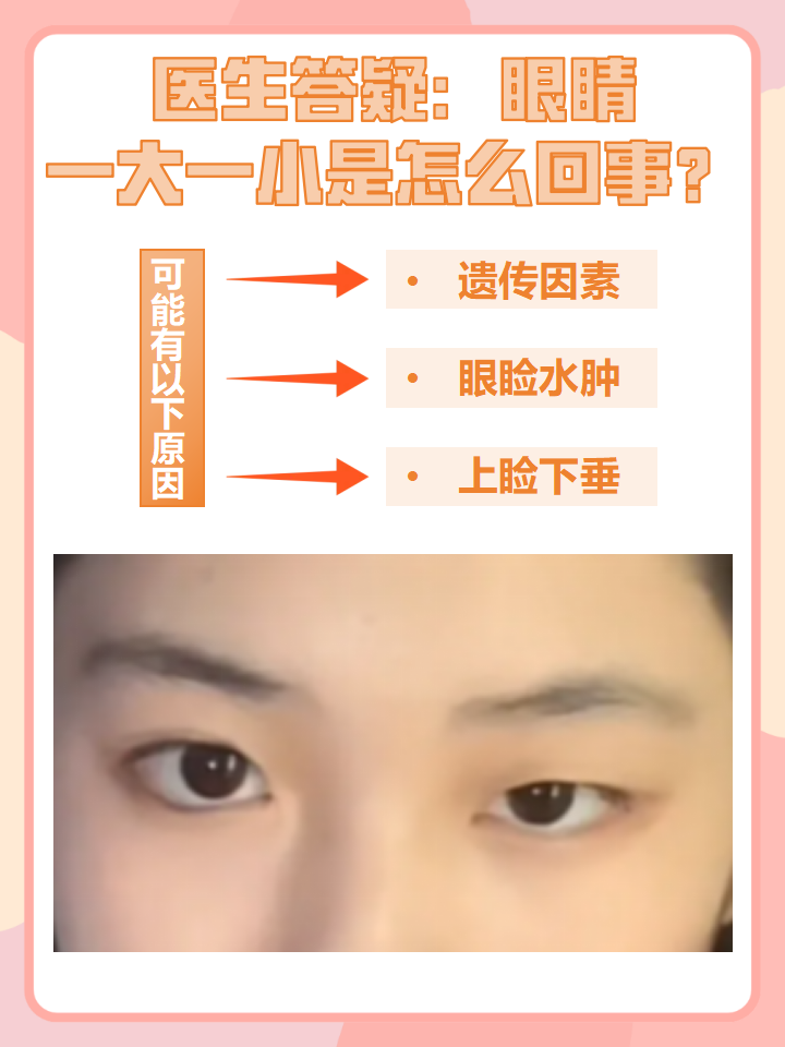 医生答疑:眼睛一大一小是怎么回事?