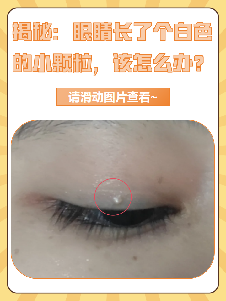 揭秘:眼睛长了个白色的小颗粒,该怎么办?