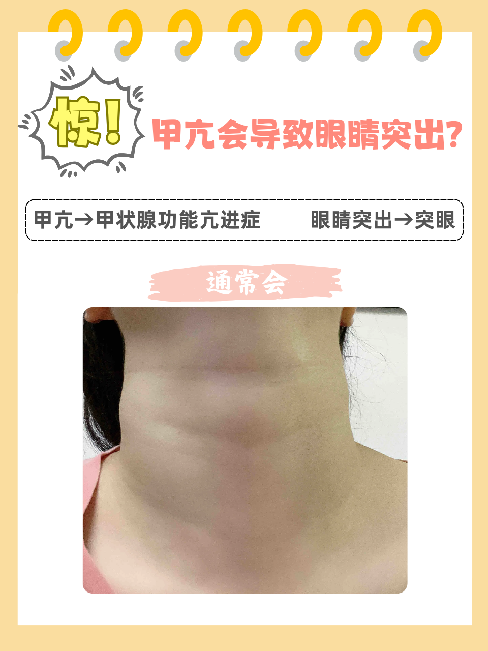 为什么会甲亢高为什么在线