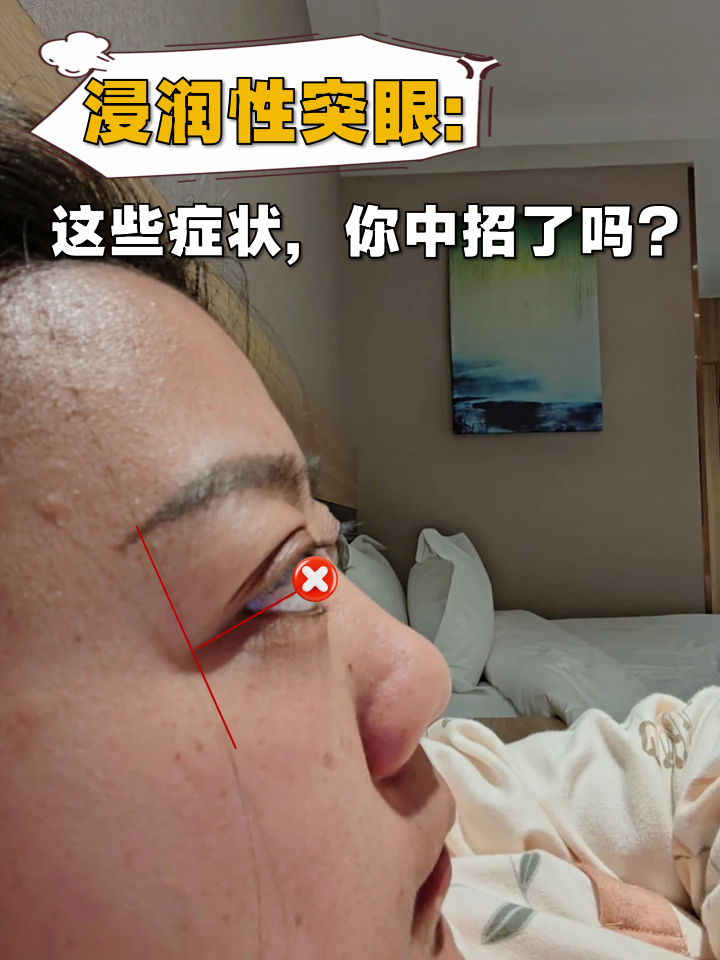 图片浸润性突眼和非浸润性突眼的区别眼球图片凸起甲亢浸润性突眼图片
