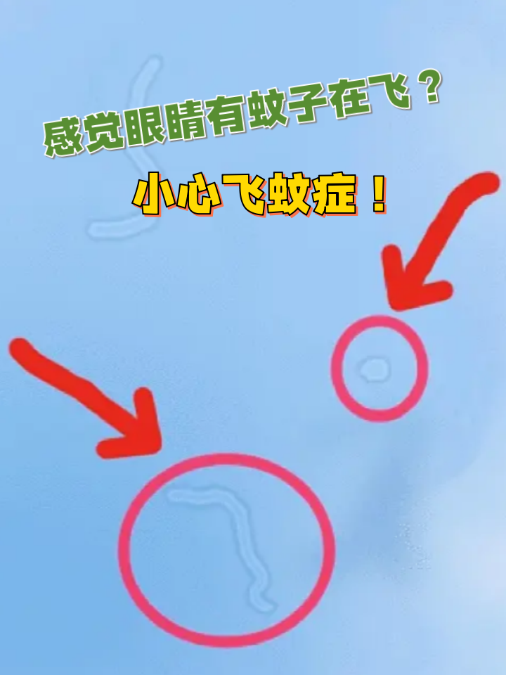 小心飞蚊症!