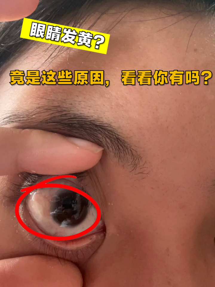 眼睛发黄可能是身体发出的预警信号,出现这种情况的原因可能是以下