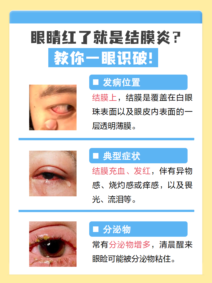 结膜炎的区分方法 发病位置 典型