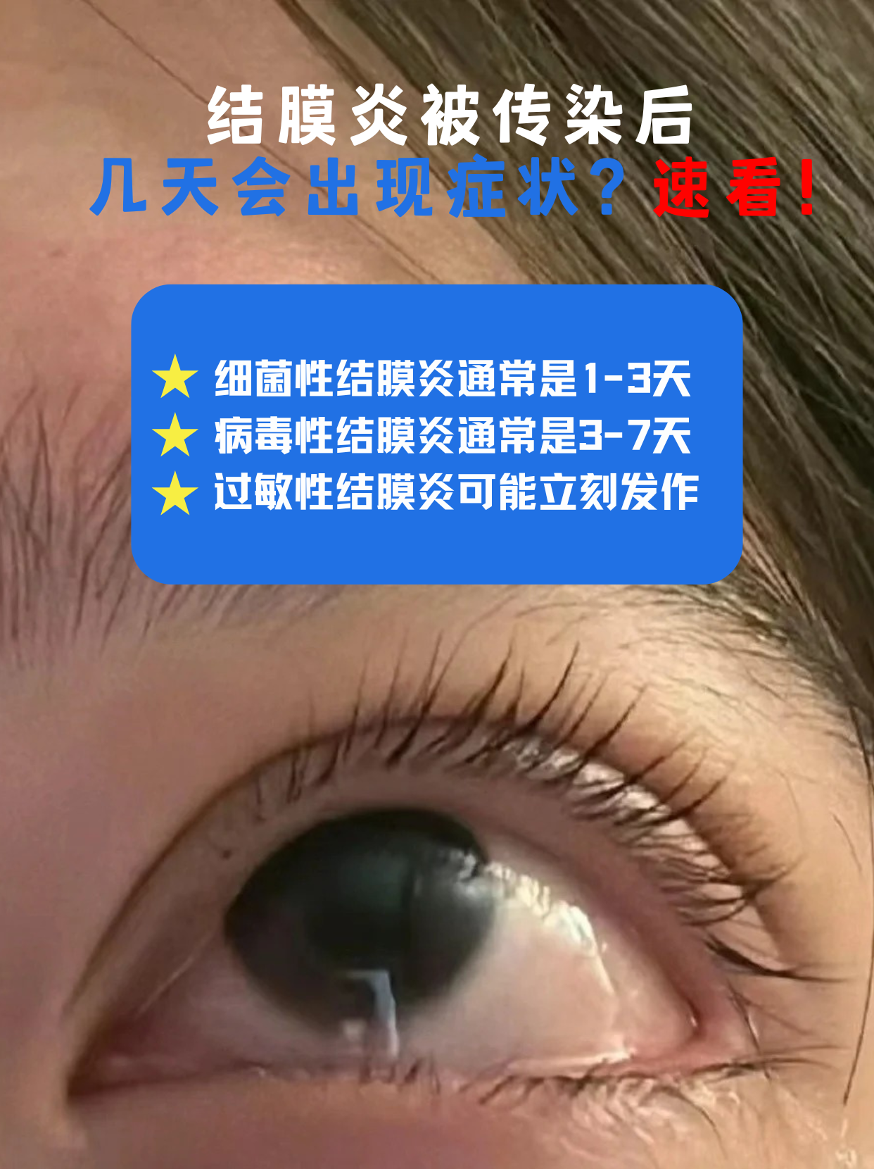 朋友刚得了"红眼病",你就开始提心吊胆?别慌!