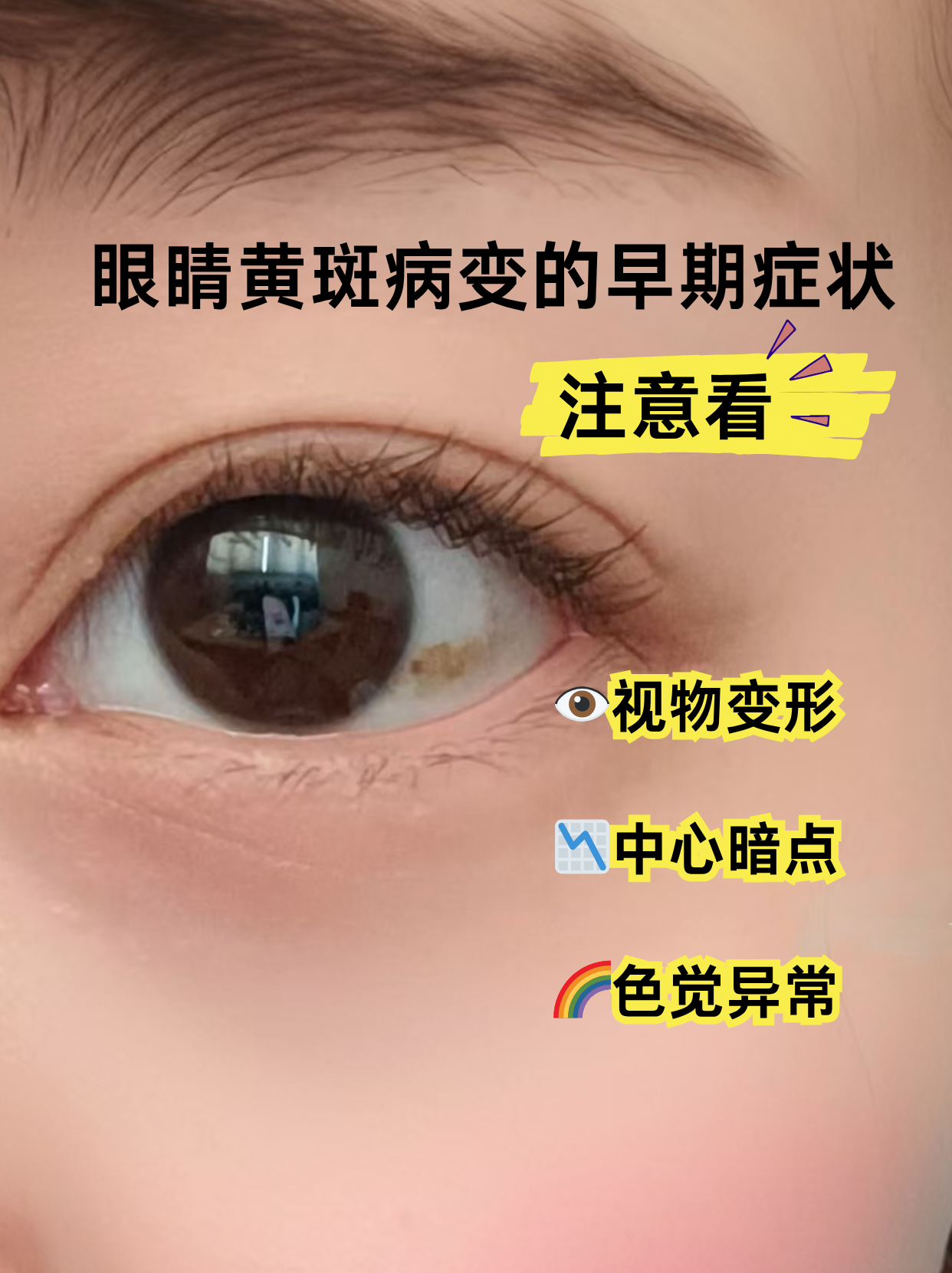 眼睛黄斑病变的早期症状,注意看