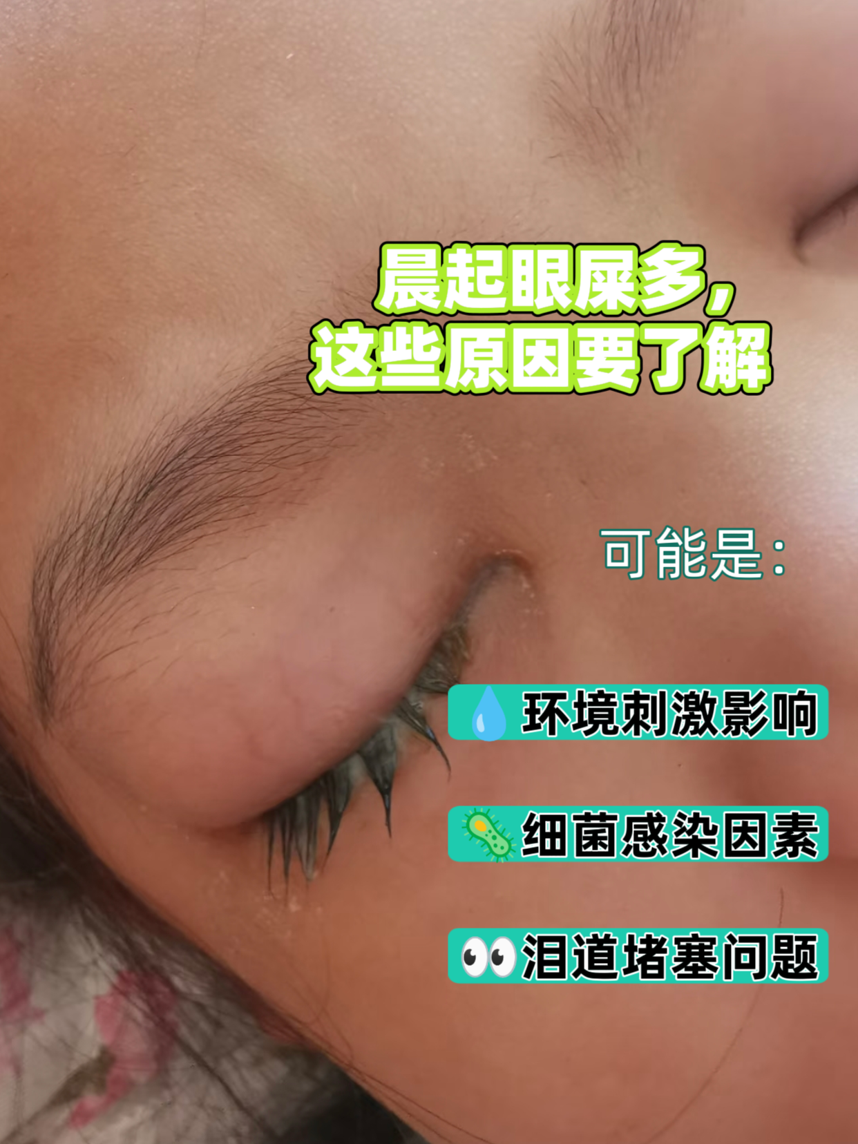 为什么眼睛总是有眼屎怎么办为什么在线 为什么眼睛总是有眼屎怎么办为什么在线