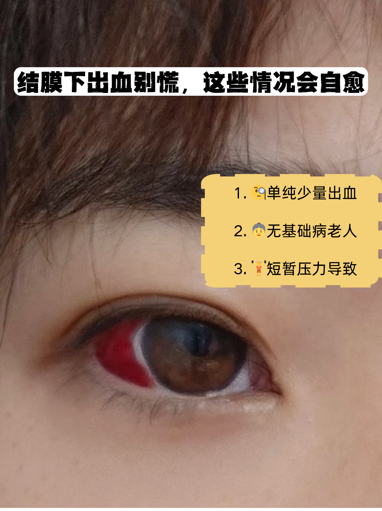 结膜下出血别慌,这些情况会自愈