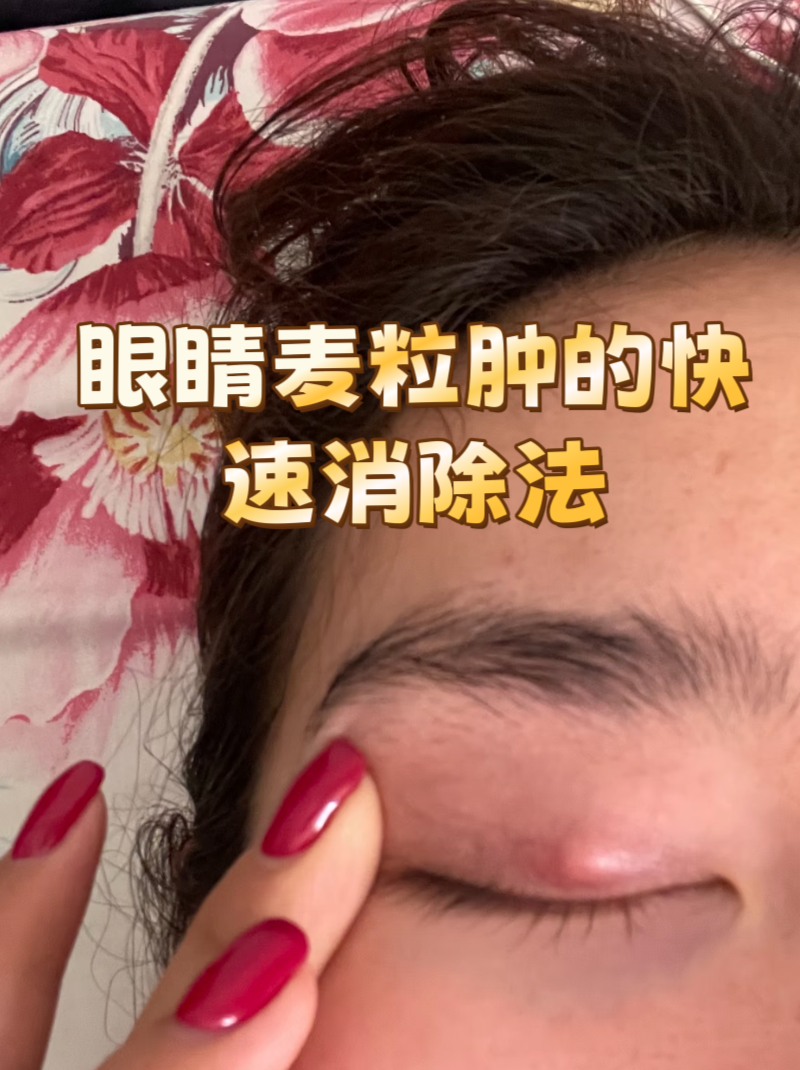 这可能是麦粒肿在作怪