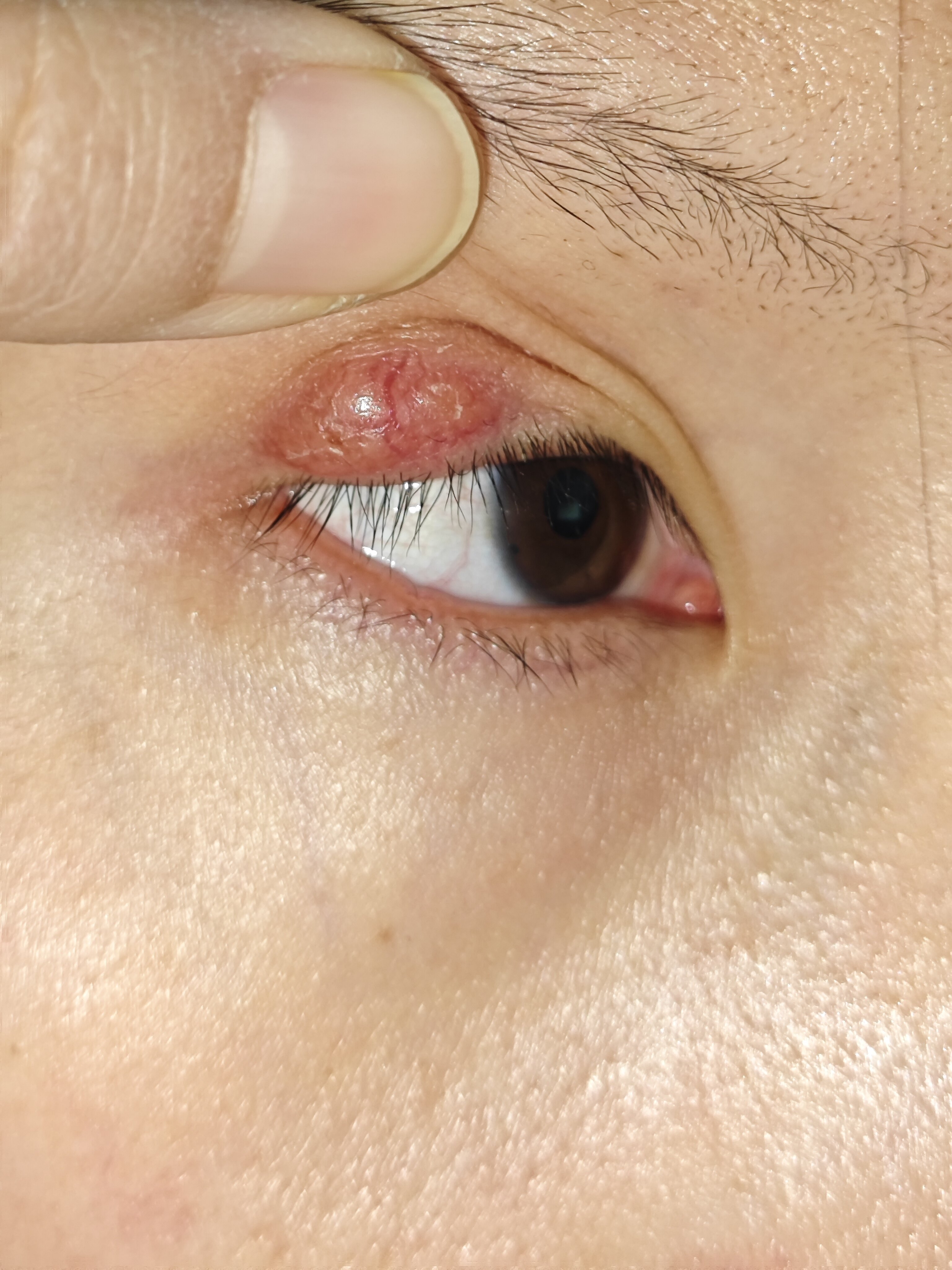 可能是麦粒肿在作怪!