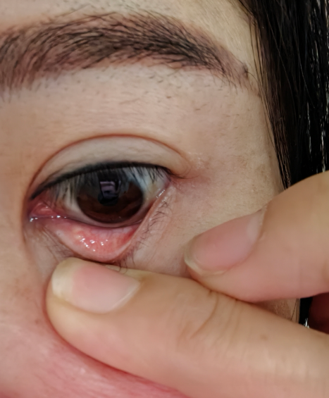 眼睛里面长疙瘩应该如何治疗