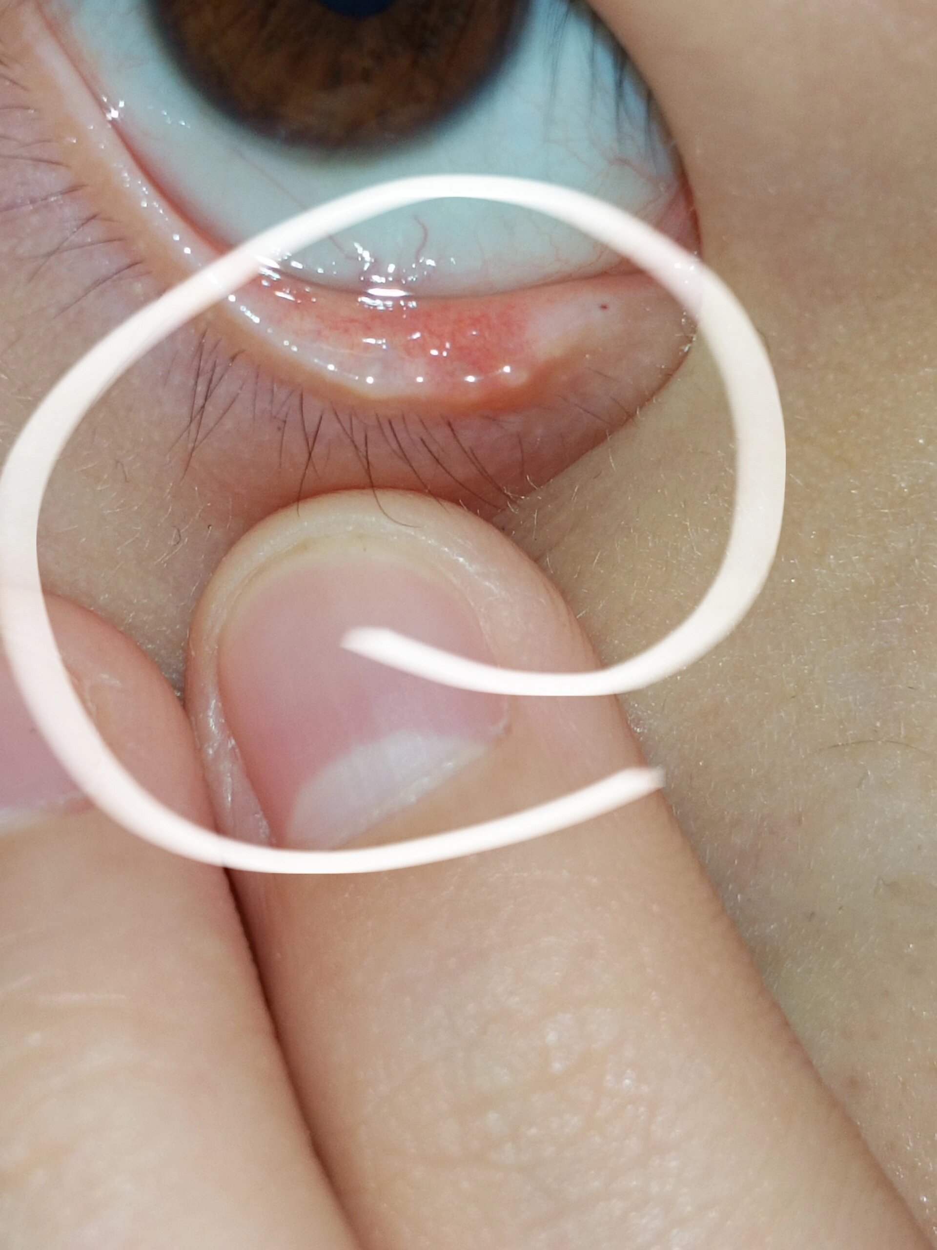 眼皮里面长了个小白点怎么办