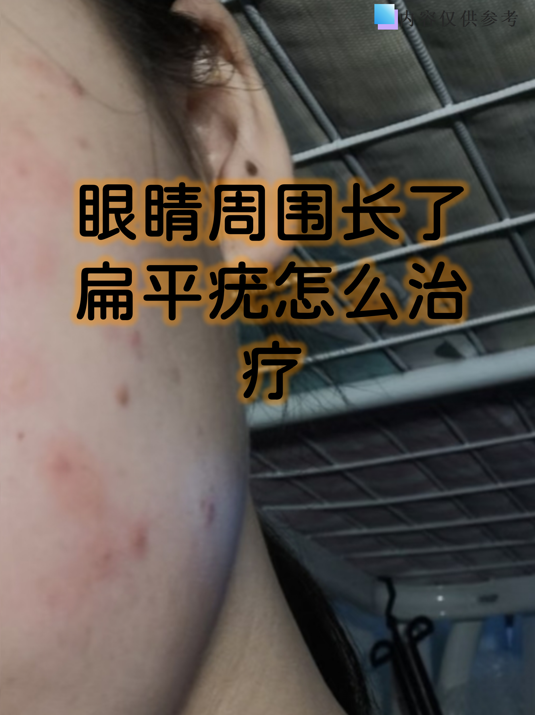 眼睛周围长了扁平疣怎么治疗