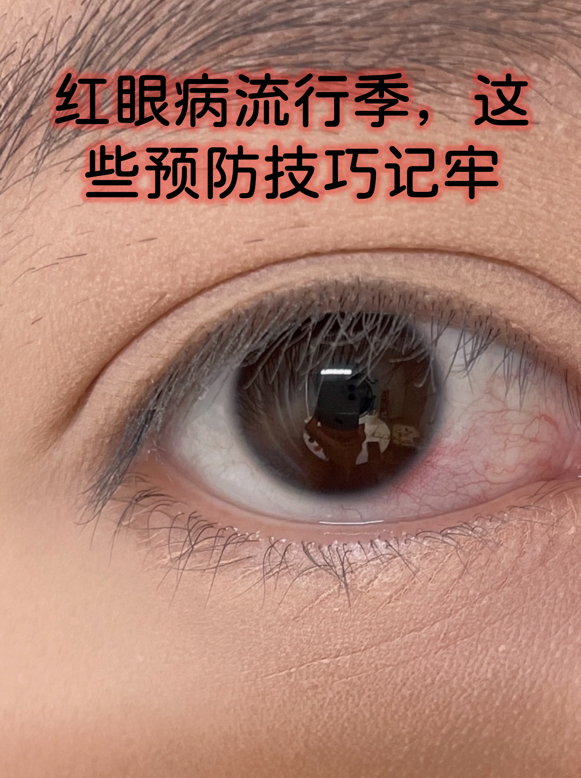 红眼病流行季,这些预防技巧记牢