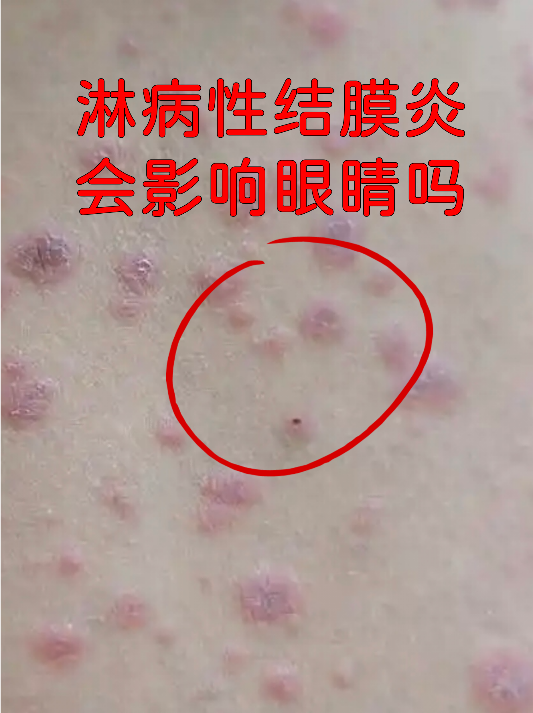 淋病性结膜炎会影响眼睛吗
