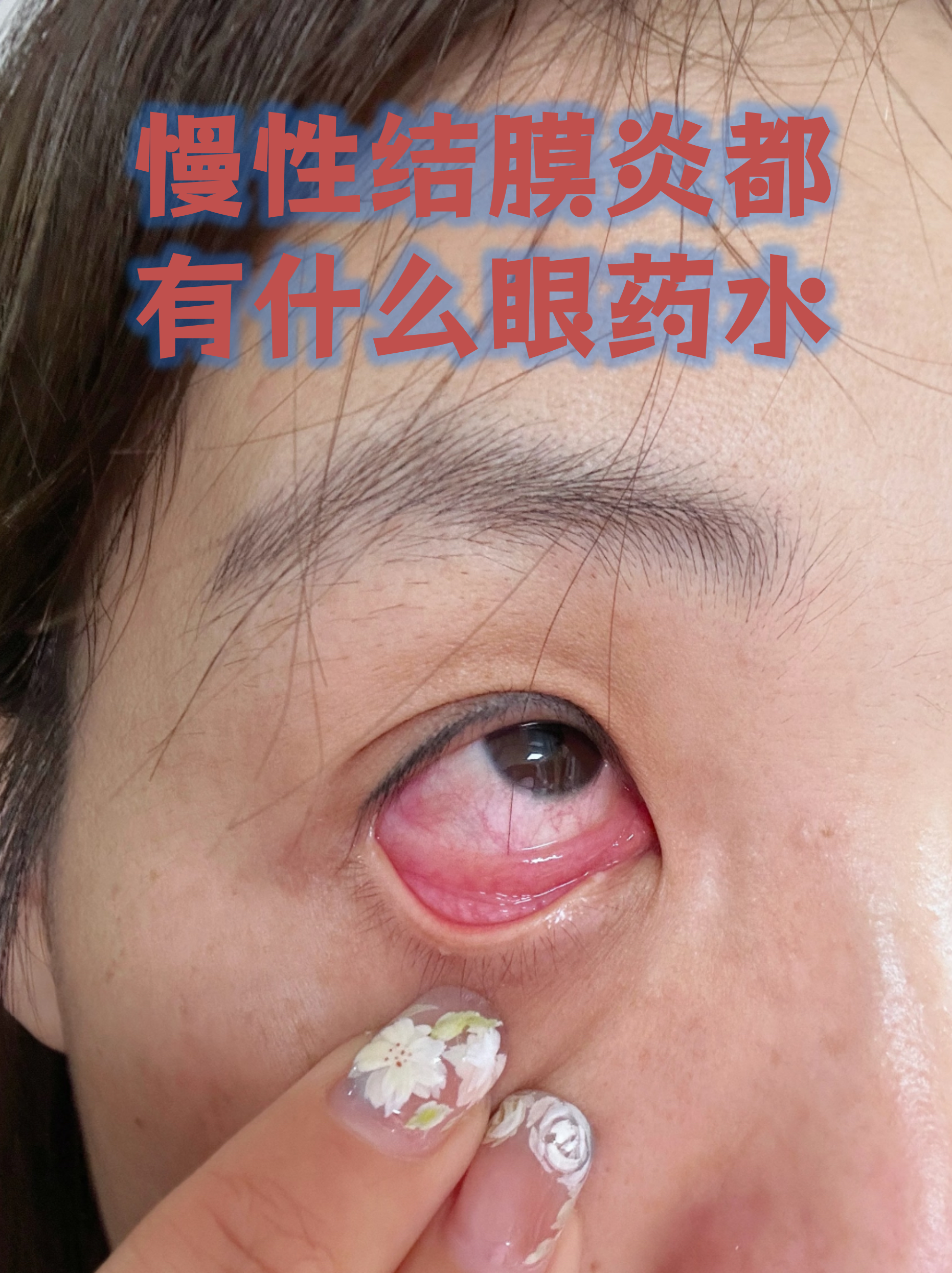 慢性结膜炎都有什么眼药水