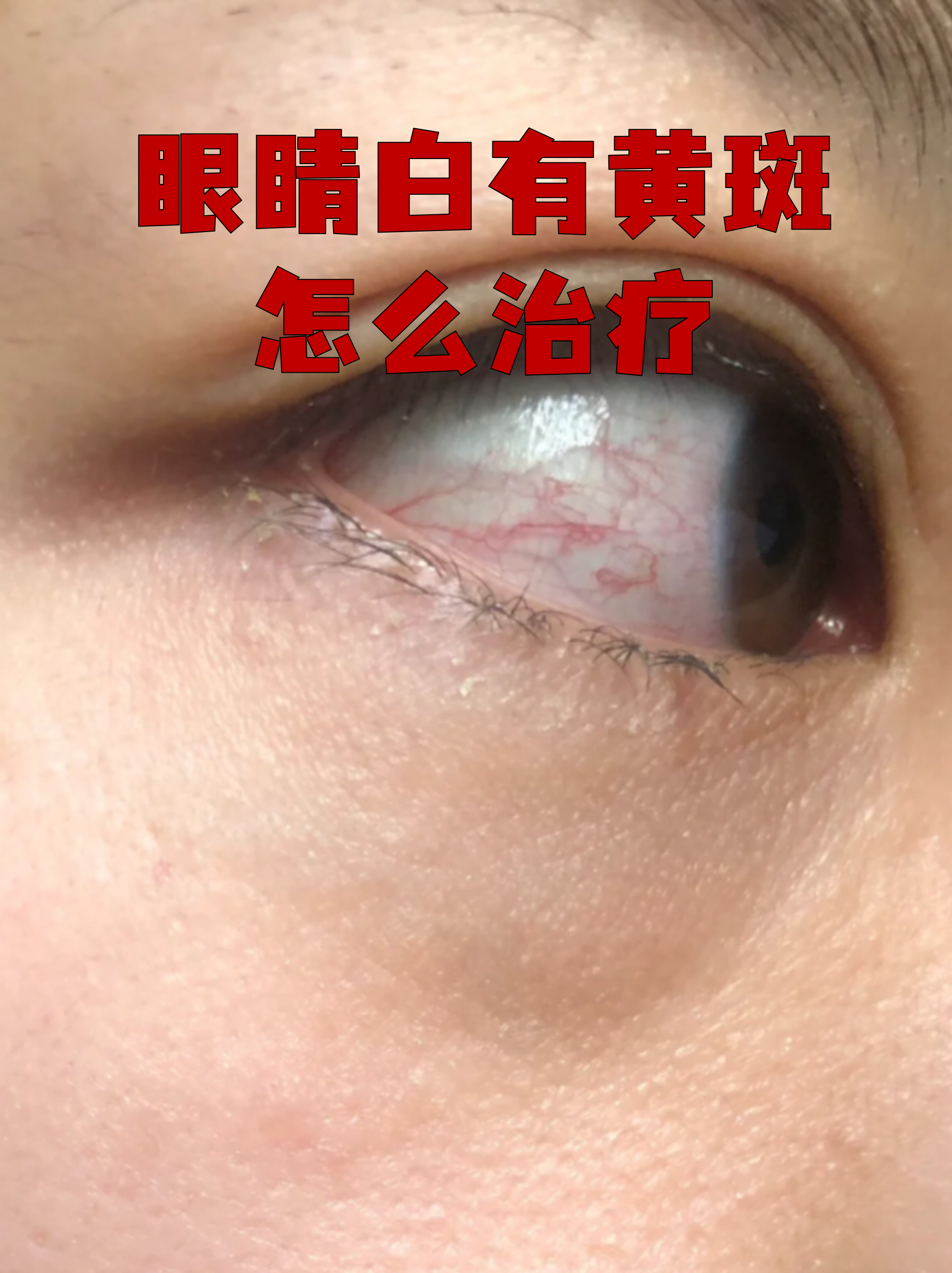 眼睛出现白眼球黄斑可能是结膜脂肪沉积或黄疸