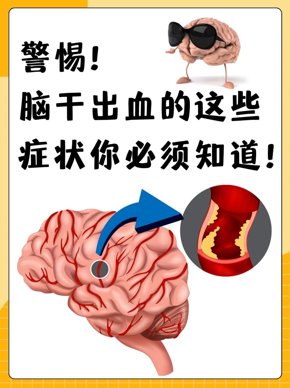 脑干出血的这些症状你必须知道!