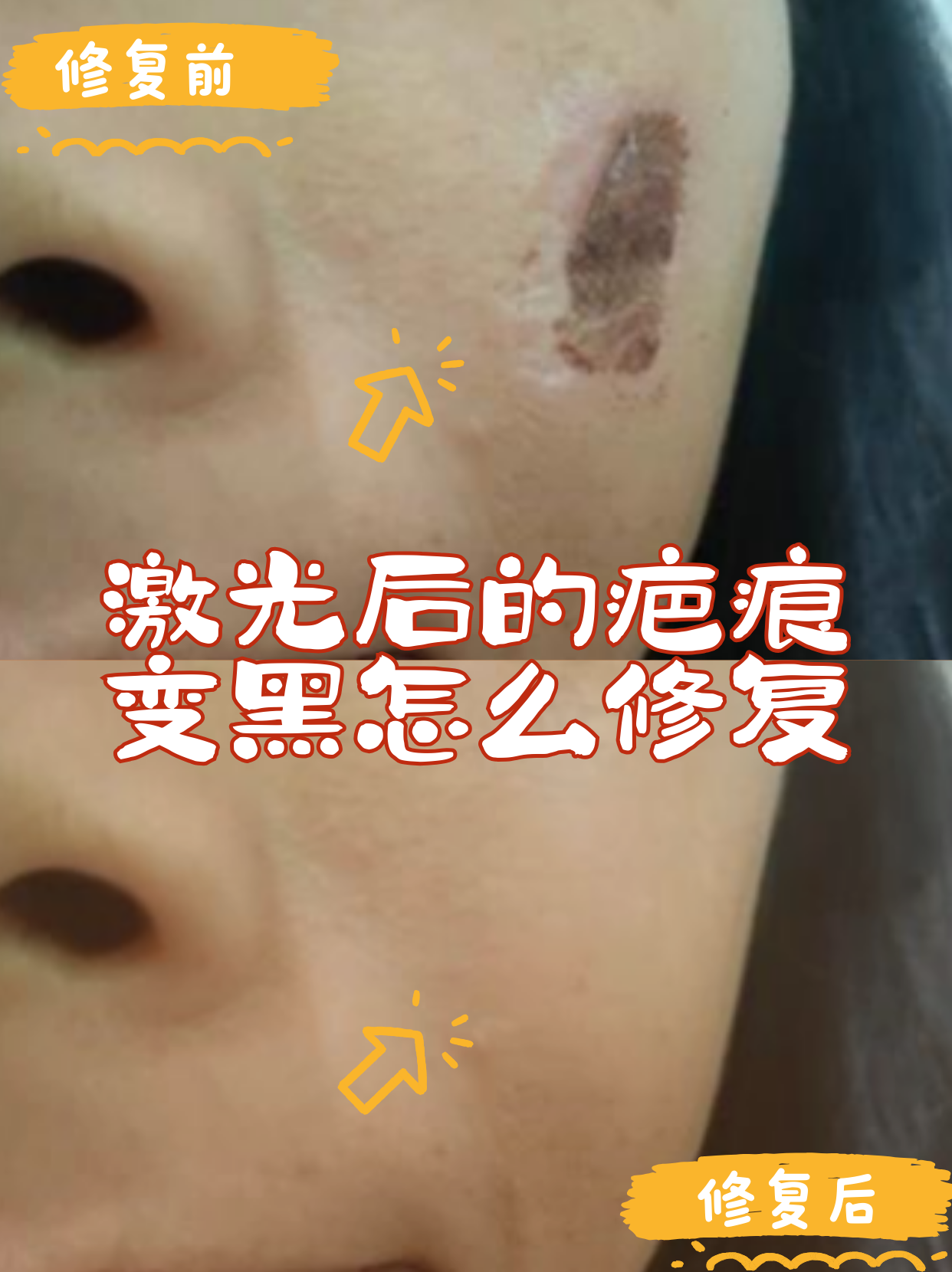 变好的颜色过程激光去疤痕色素沉淀的恢复过程激光治疤痕色素沉着
