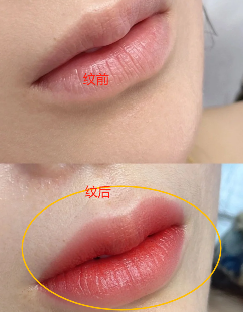 纹唇后为什么不能同房