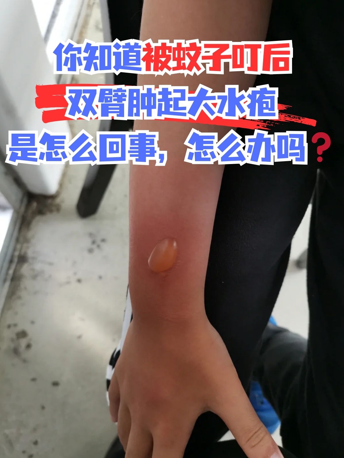 被叮咬长水泡为何手臂上突然长疱疹蚊子咬后透明水泡图片被蚊子咬到包