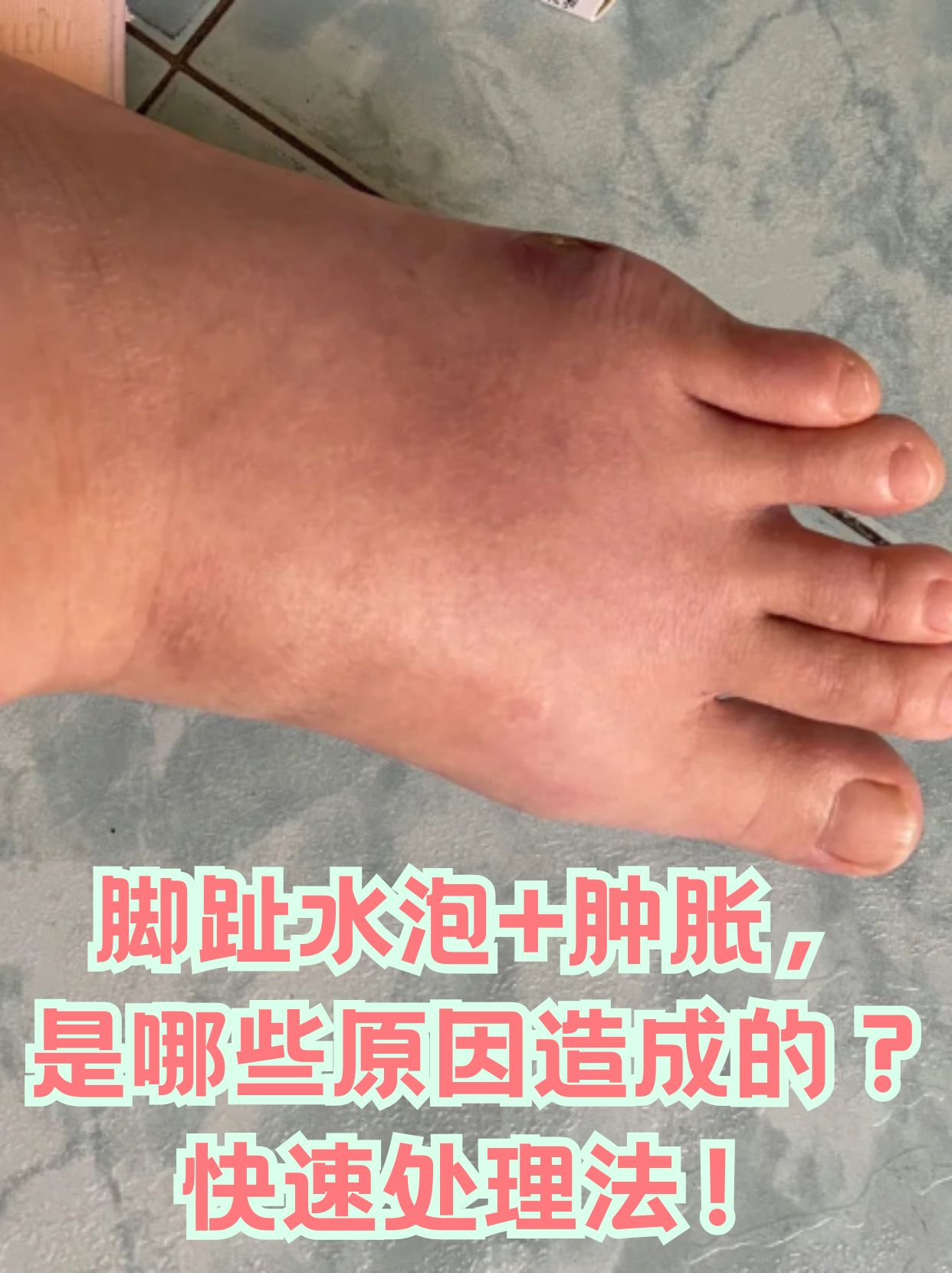 脚为什么会长水泡,还很痒?为什么在线