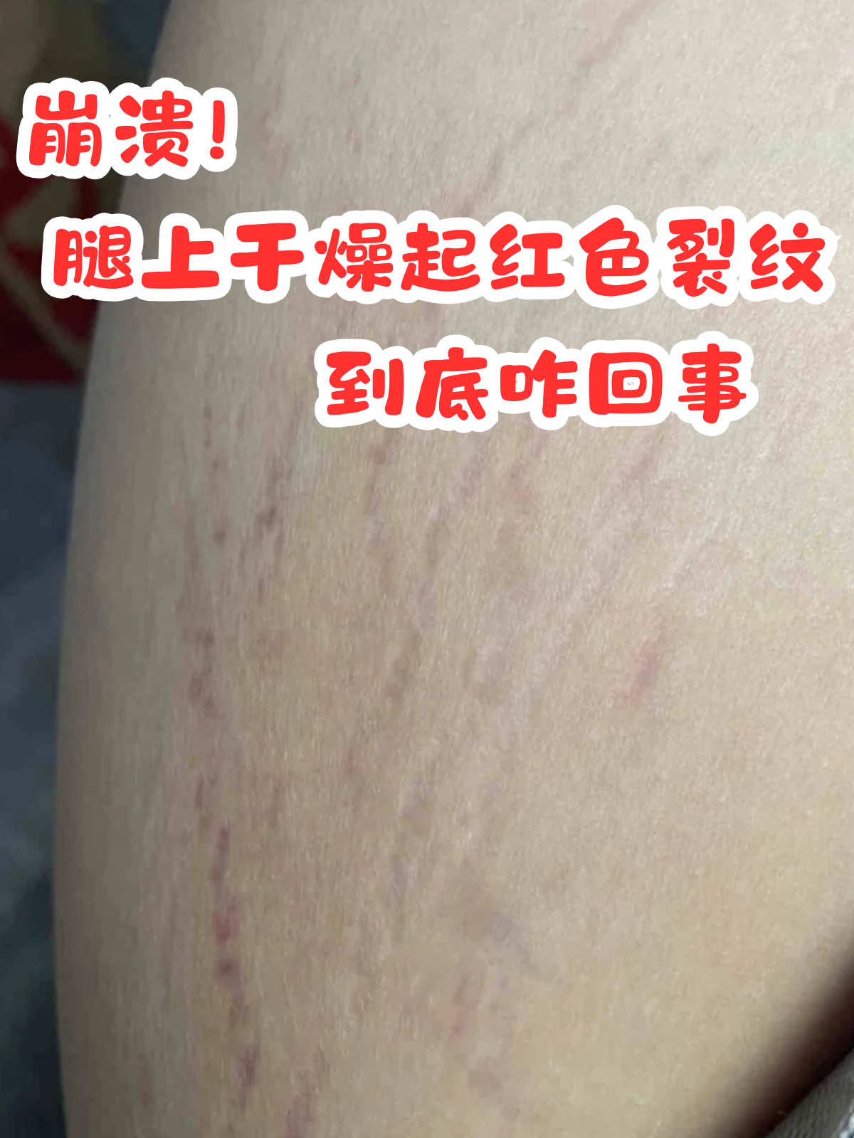 到底咋回事 不知道你们有没有遇到过腿上皮肤干燥,还出现红色裂纹的