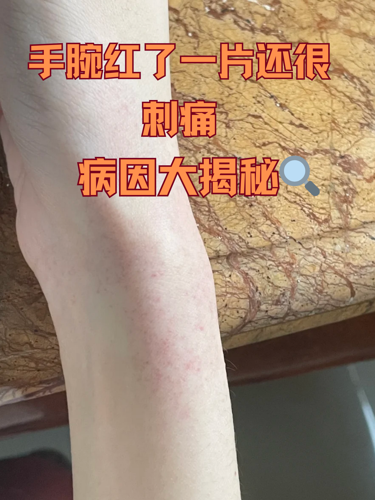 手腕过敏起红疹子图片手腕过敏艾滋病手腕红印图片女性腕管炎的症状